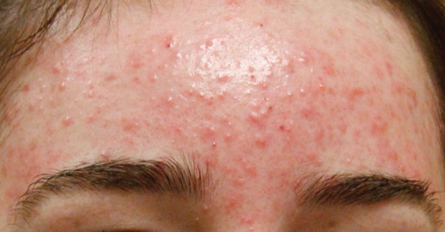 Cách trị mụn trứng cá vùng trán