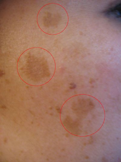 Một số thông tin về nám da