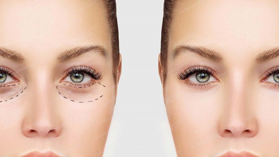 Các biến chứng sau cắt mí dưới