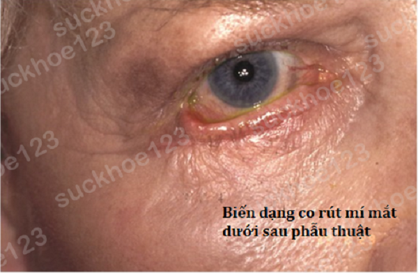 Co rút mi sau phẫu thuật cắt mí dưới