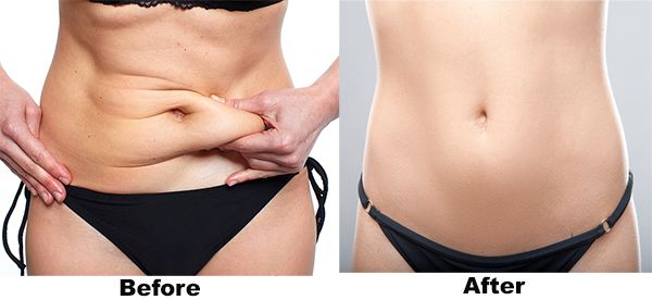 Tư vấn thẩm mỹ: các câu hỏi thường gặp về hút mỡ