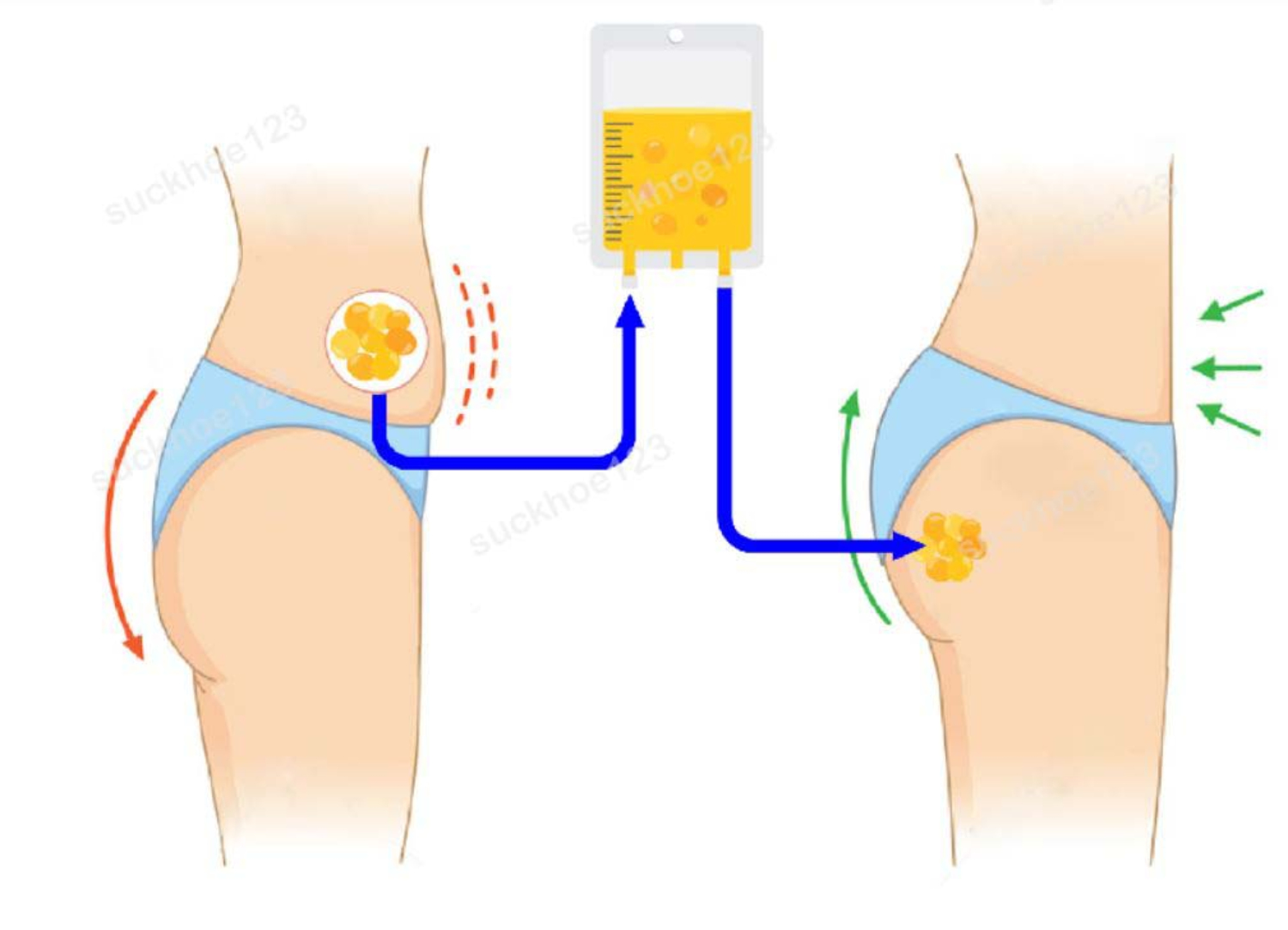 Nâng Mông Bằng Mỡ Tự Thân Kiểu Brazil (BBL)