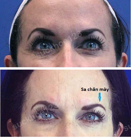 Chân mày sa sụp, hạ thấp, không cân đối sau tiêm Botox