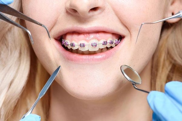 Công nghệ chỉnh nha ngày nay đã thay đổi như thế nào?
