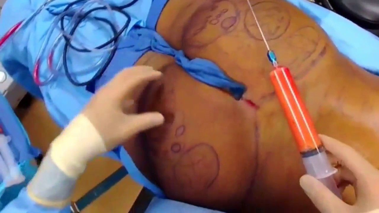 Chỉnh sửa nâng mông hỏng