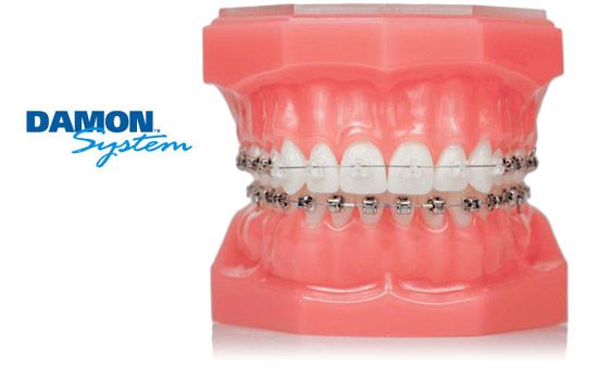 Niềng răng mắc cài sứ Damon giá bao nhiêu?