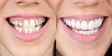 dan su veneer