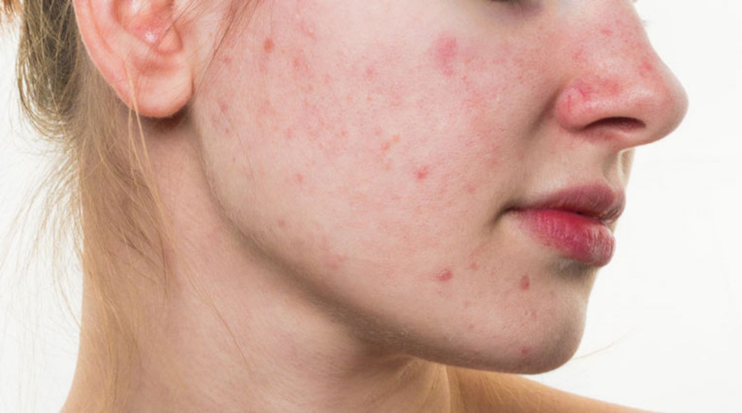 Trị bệnh trứng cá đỏ bằng một loại bọt mới