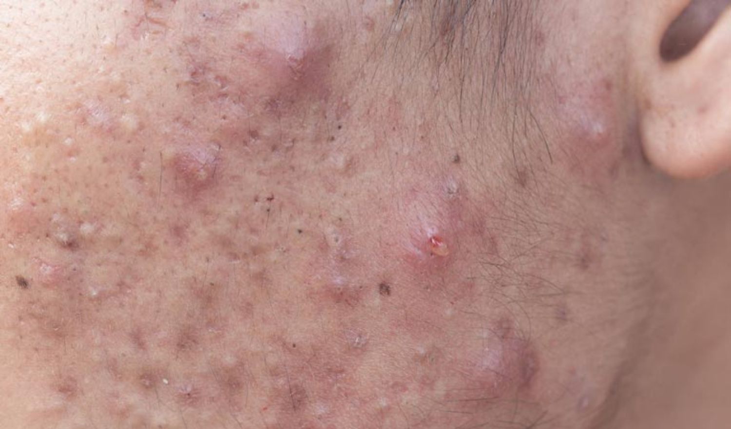 Tìm hiểu và điều trị mụn bọc