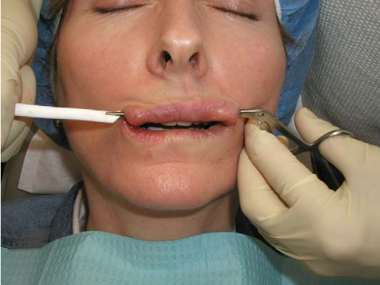 Độn môi implant