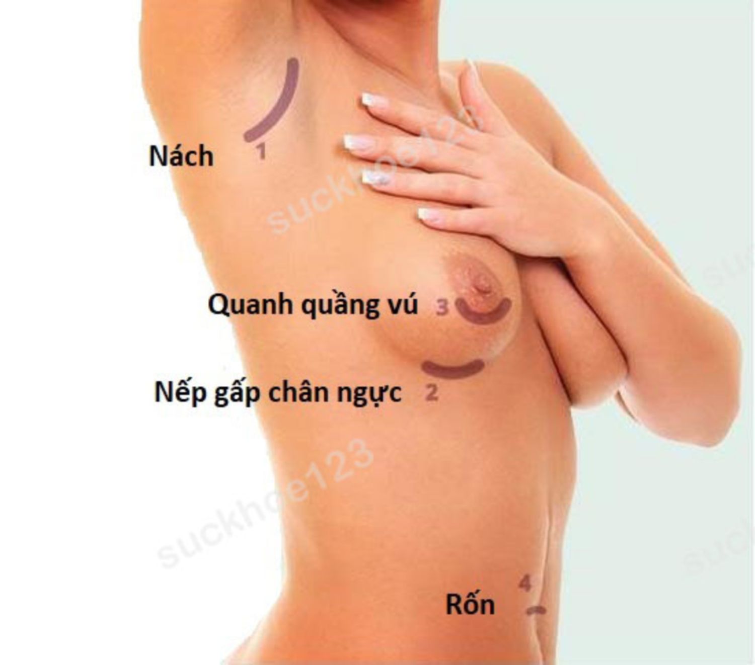 Các đường rạch mổ trong nâng ngực bằng túi độn