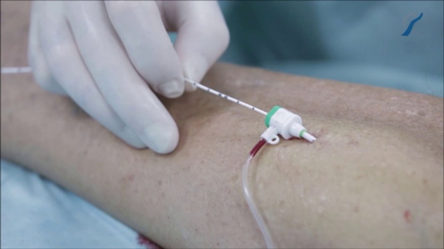 10 câu hỏi thường gặp về laser nội tĩnh mạch