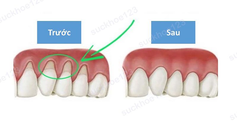 Ghép lợi điều trị tụt lợi