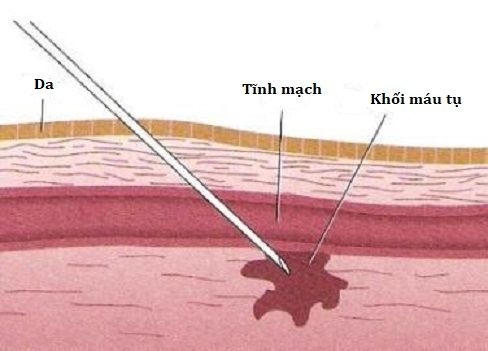 Tụ máu sau phẫu thuật thẩm mỹ