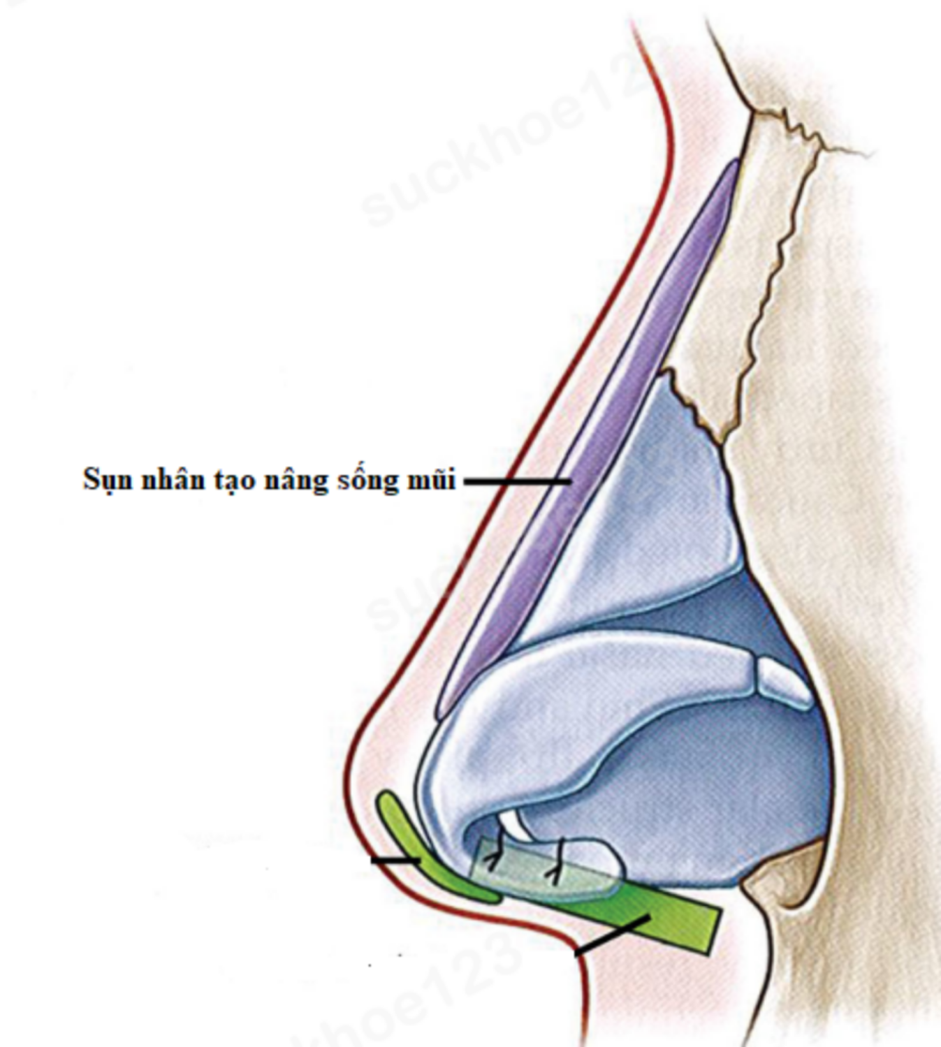Tổng hợp các loại sụn nhân tạo sử dụng trong nâng mũi