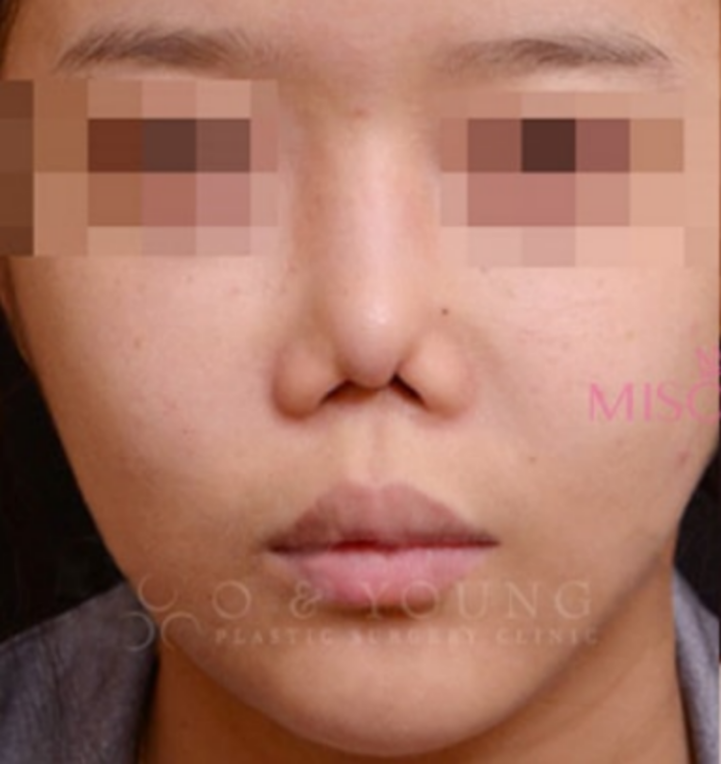 Mũi co rút, biến dạng sau nâng: nguyên nhân và cách xử lý