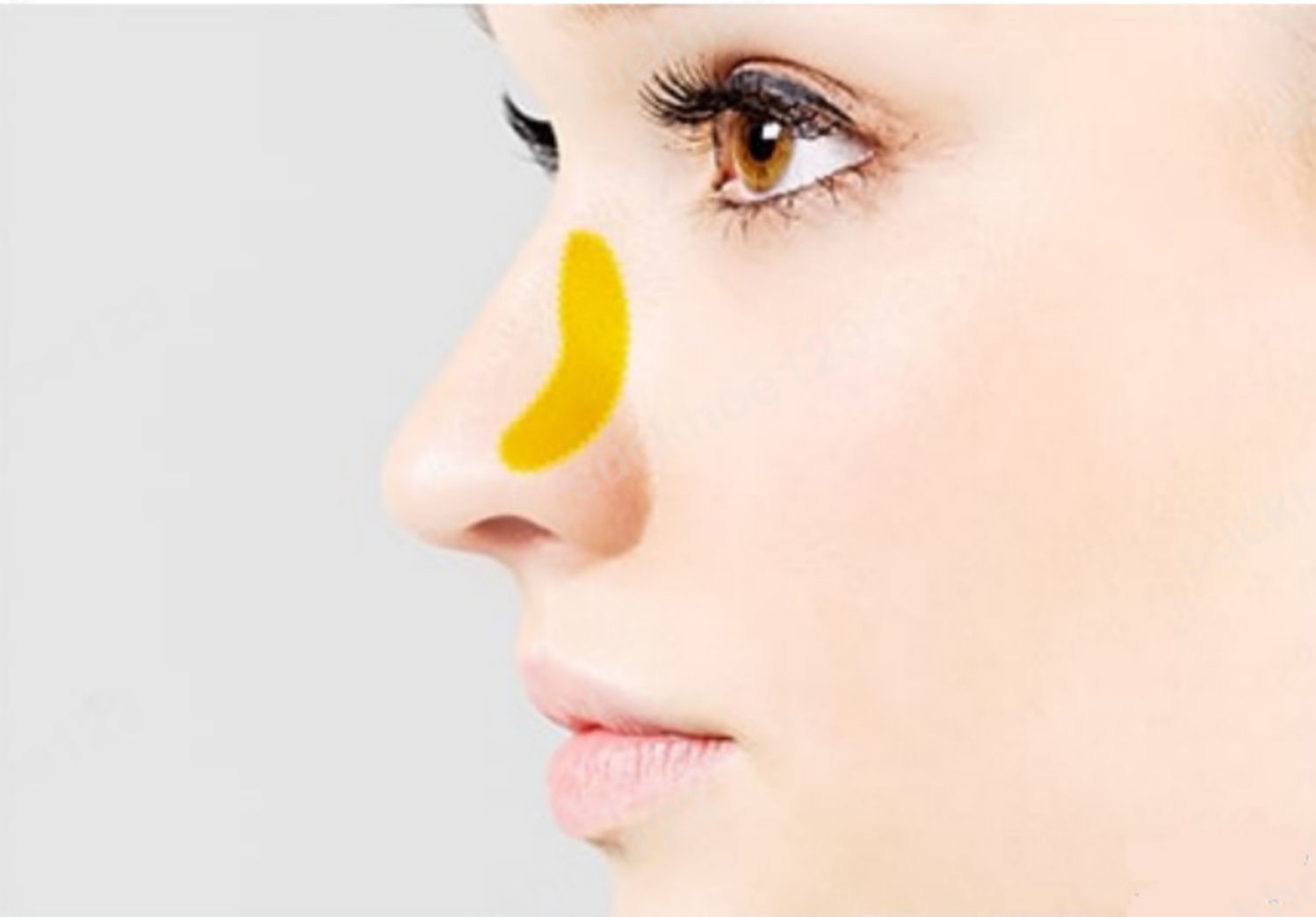 Nâng mũi cấu trúc sử dụng sụn vách ngăn