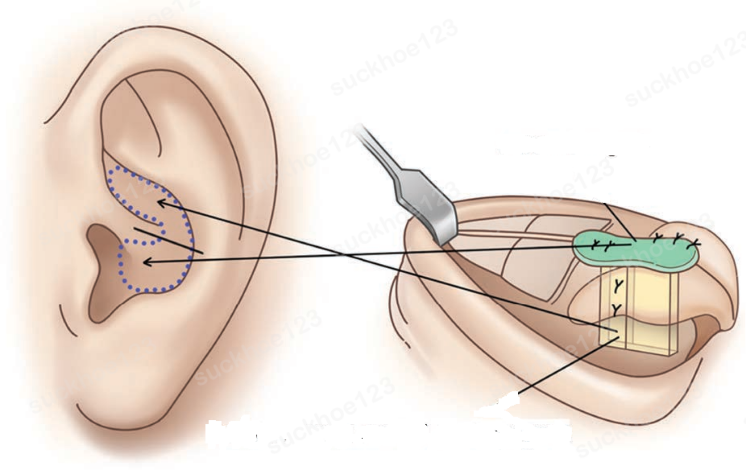 Nâng mũi cấu trúc bọc sụn tai