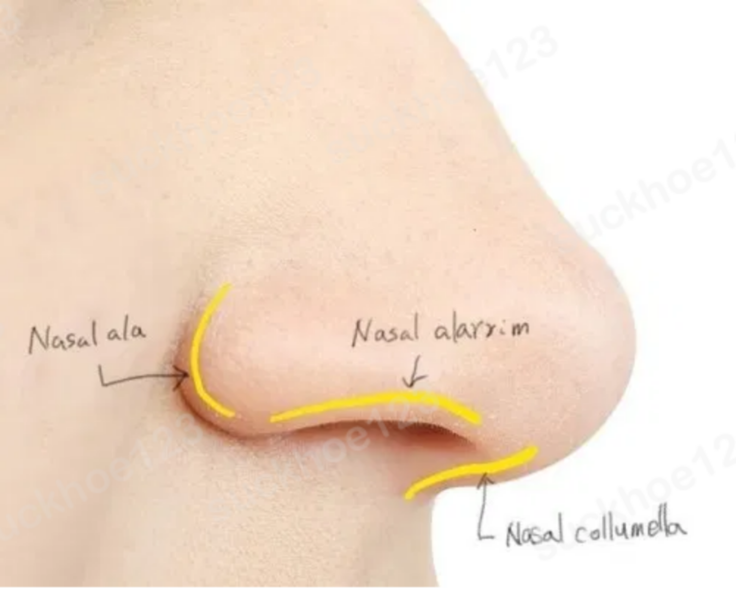 Phẫu Thuật Chỉnh Hình, Thu Gọn Cánh Mũi