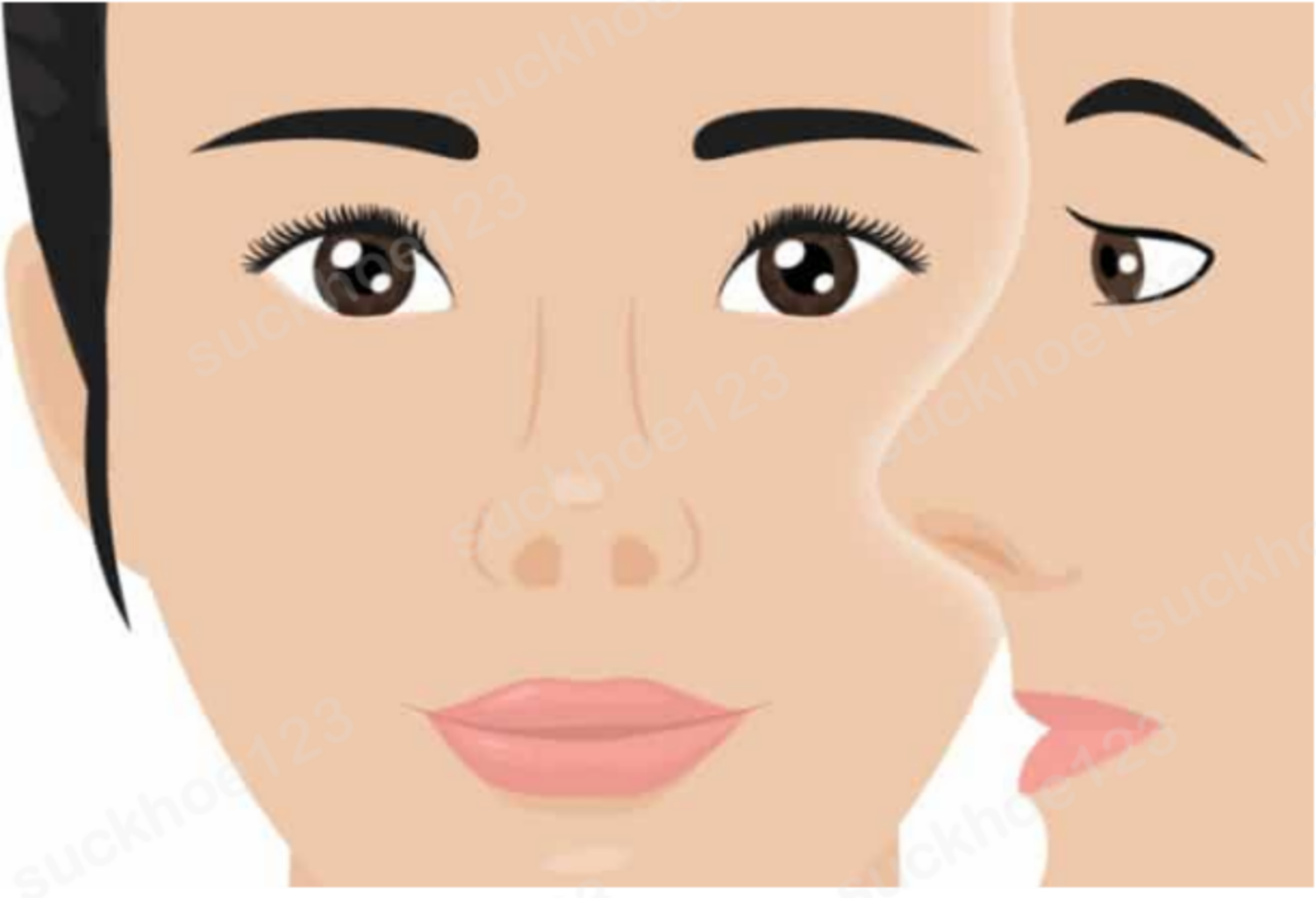 Nâng mũi cấu trúc khắc phục mũi ngắn, hếch