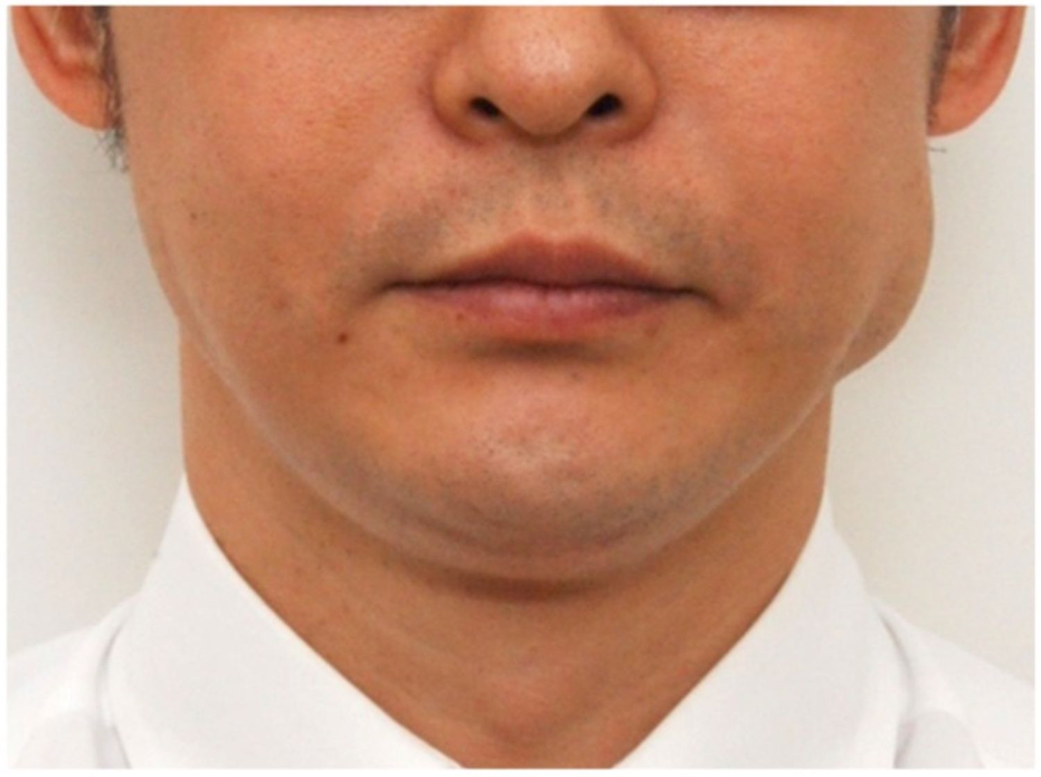 Hàm sưng phình bất thường sau tiêm botox thon gọn hàm