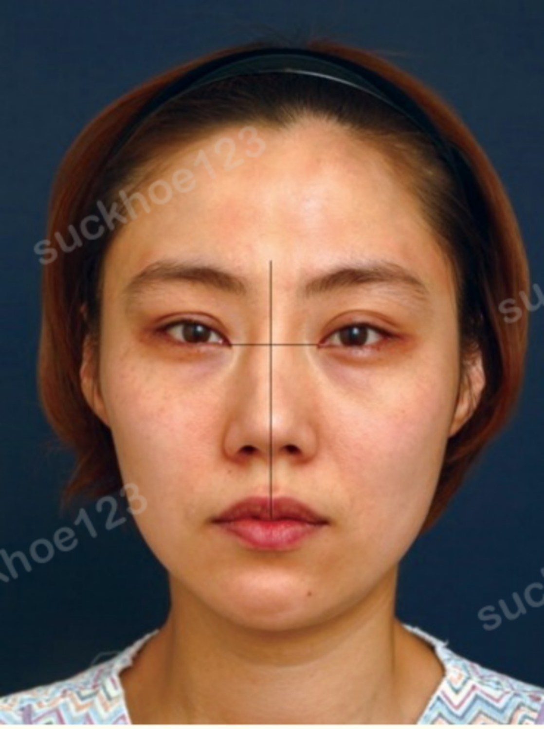 Các biến chứng có thể gặp phải sau chỉnh sửa mũi lệch, xoắn