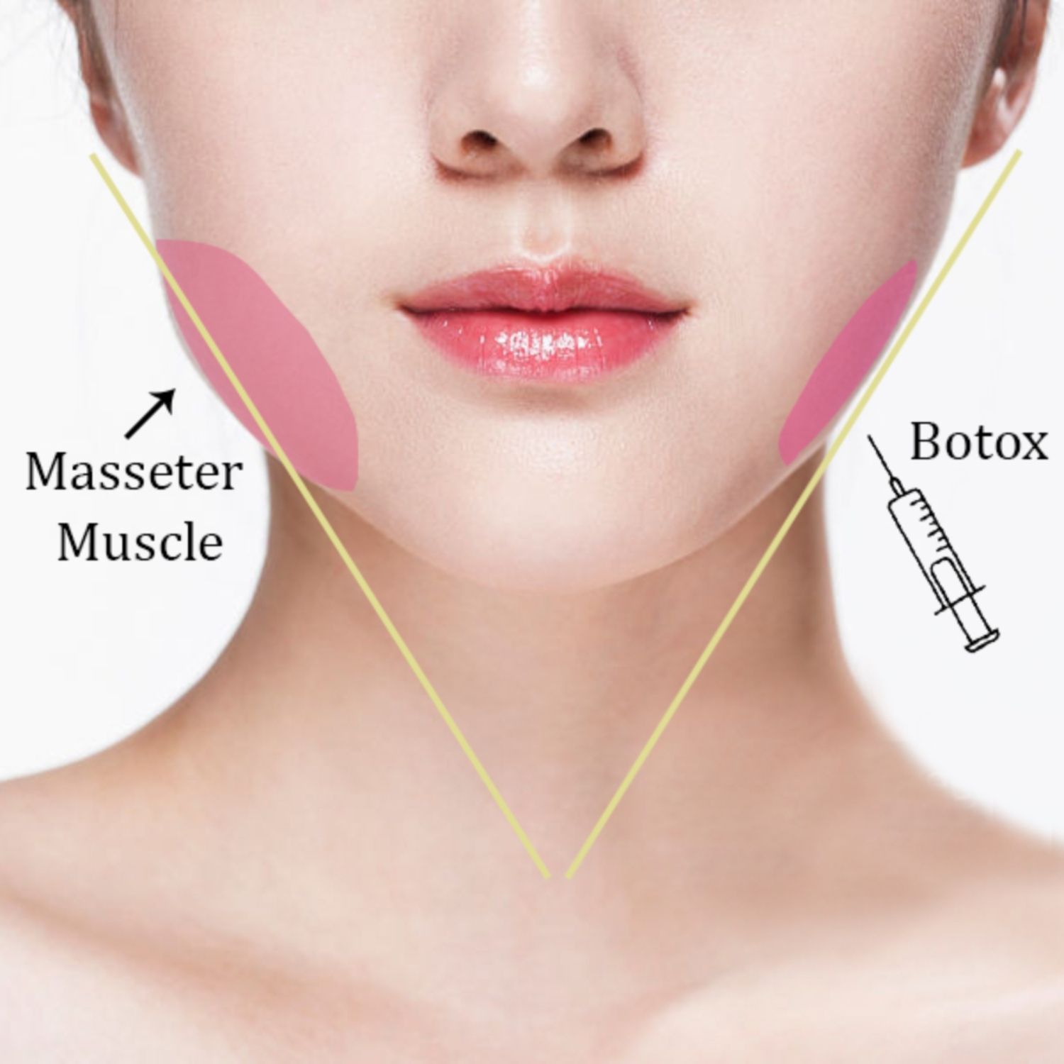 Phương Pháp Tiêm Botox Gọn Hàm