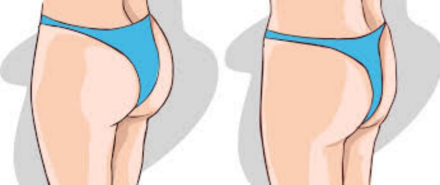 Tháo bỏ túi độn mông