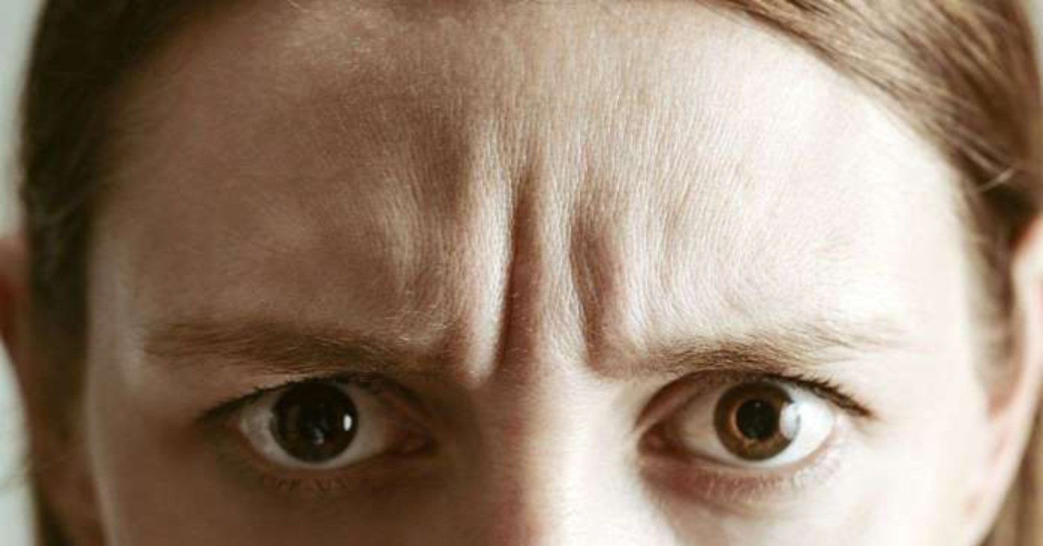 Tiêm botox xóa nếp cau mày (nếp nhăn giữa hai đầu lông mày)