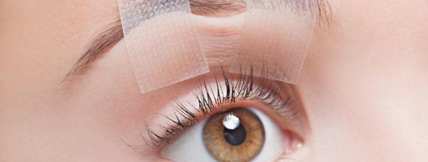 Sụp mí do tiêm Botox thẩm mỹ