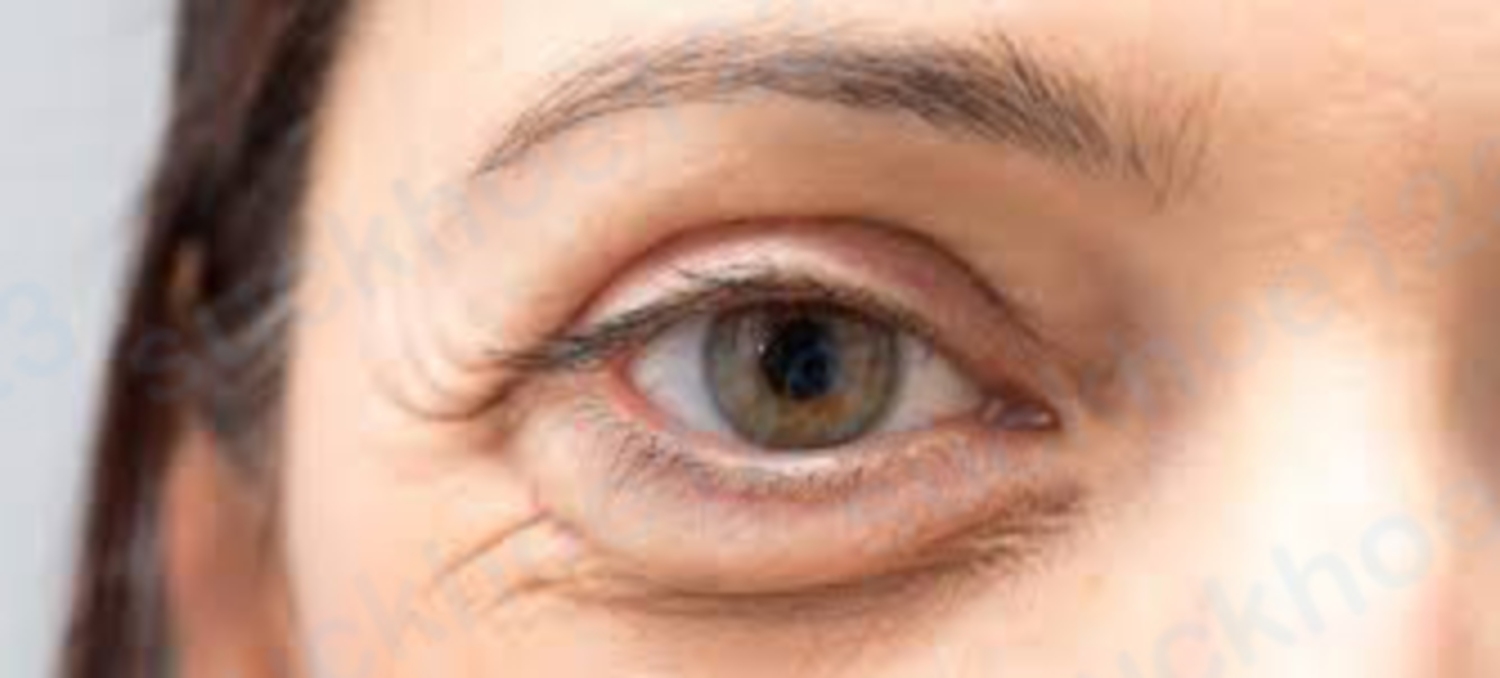 Cách trị bọng mắt hiệu quả