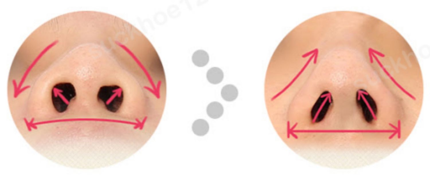 Nâng mũi cấu trúc chỉnh sửa mũi thấp, tẹt