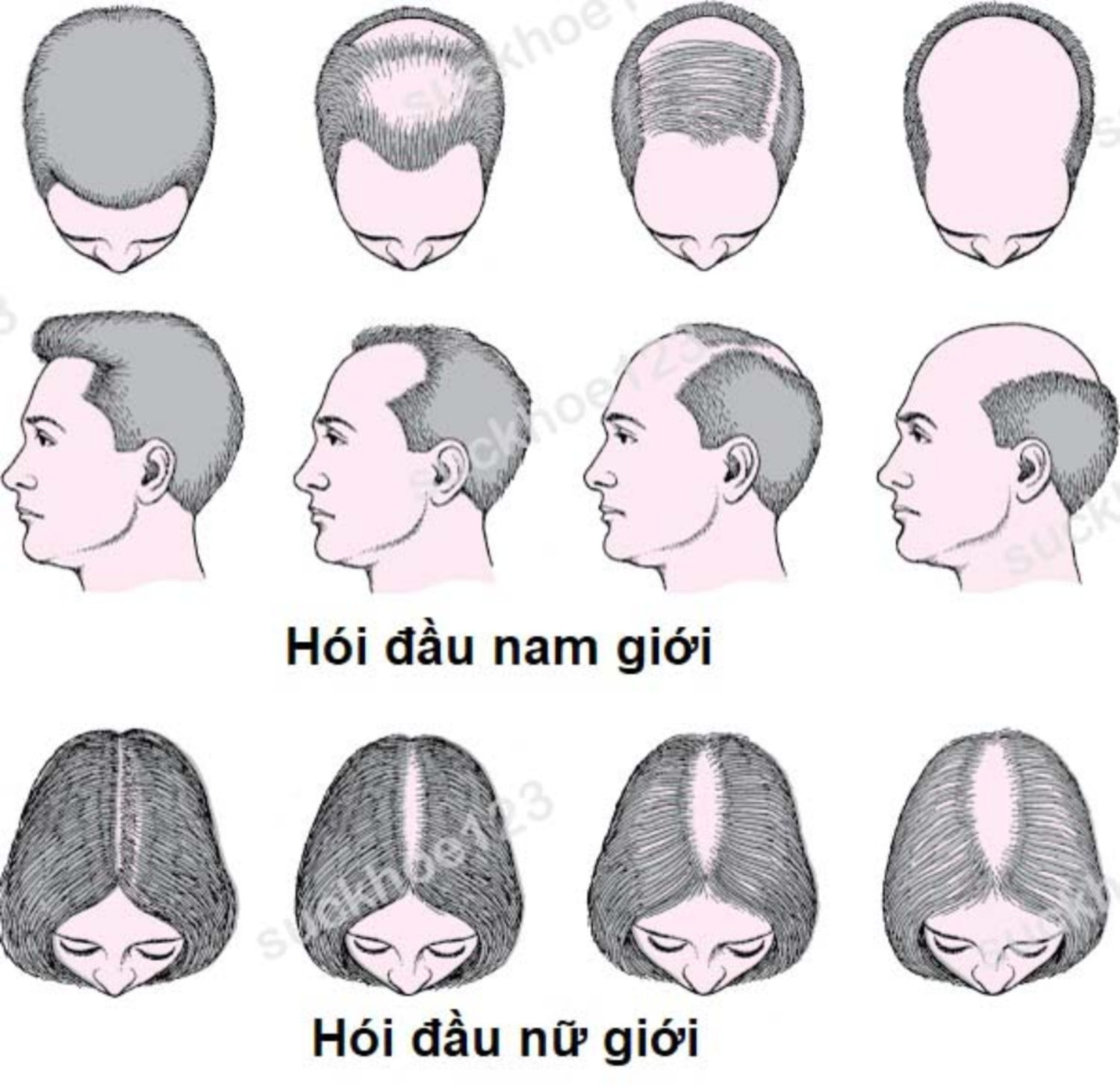 Hói đầu: nguyên nhân và cách điều trị