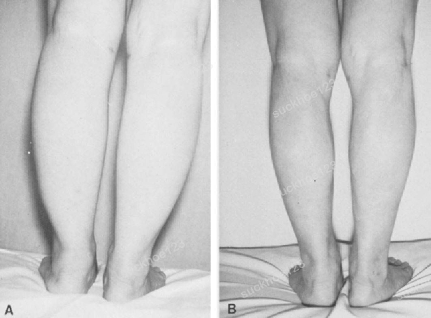 Hút Mỡ Bắp Chân: Những Điều Cần Biết