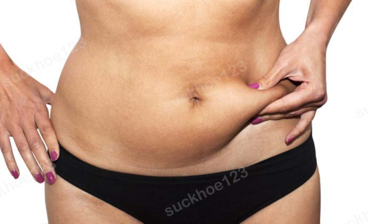Hút mỡ bụng: những điều cần biết