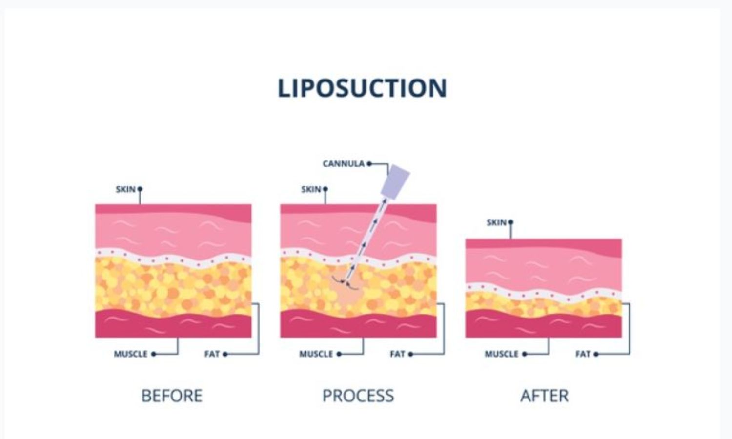Những Điều Cần Biết Về Hút Mỡ Bụng, Ụ Hông, Đùi, Nọng Cằm, Cánh Tay