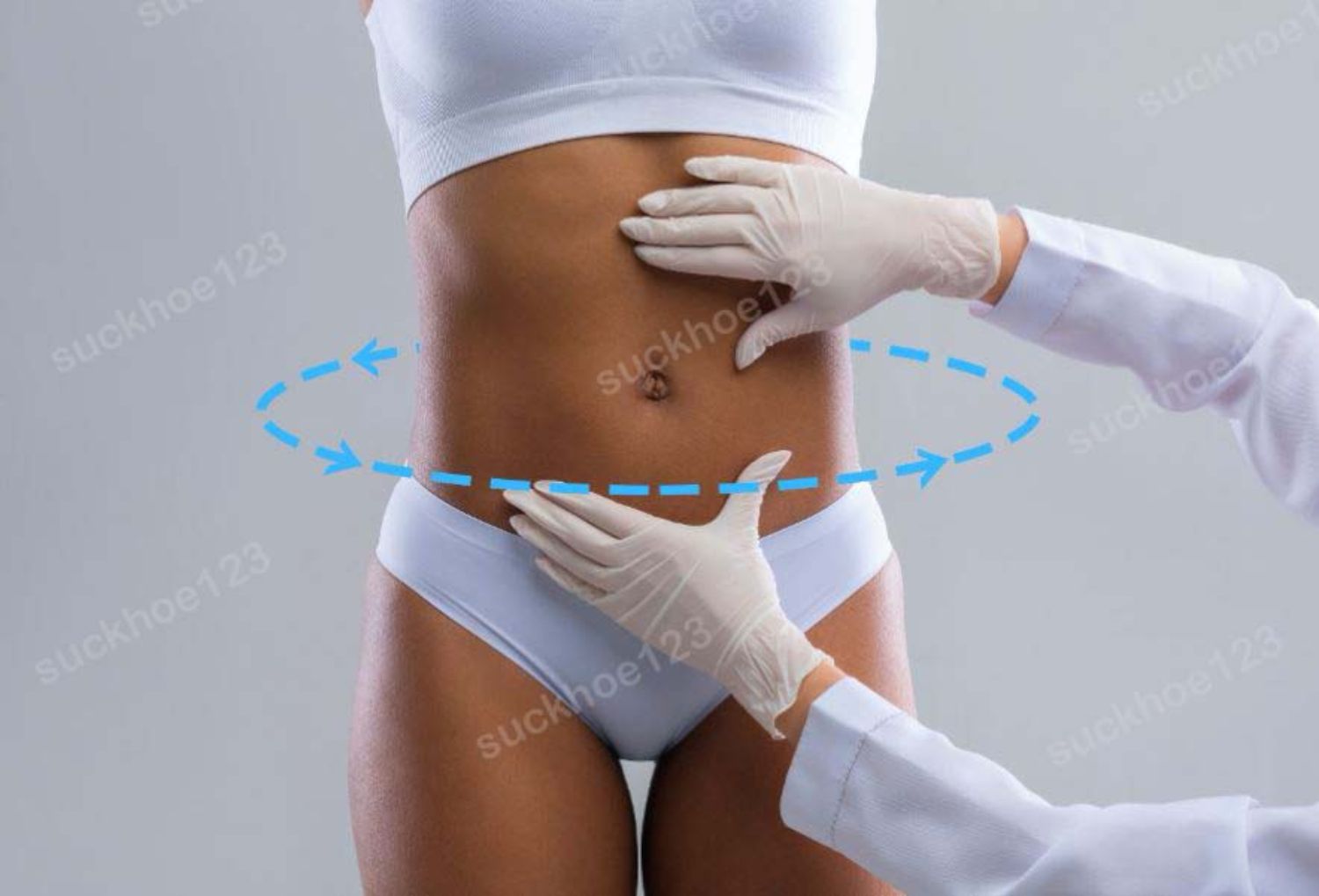 Hút mỡ toàn diện (Lipo 360) là gì?