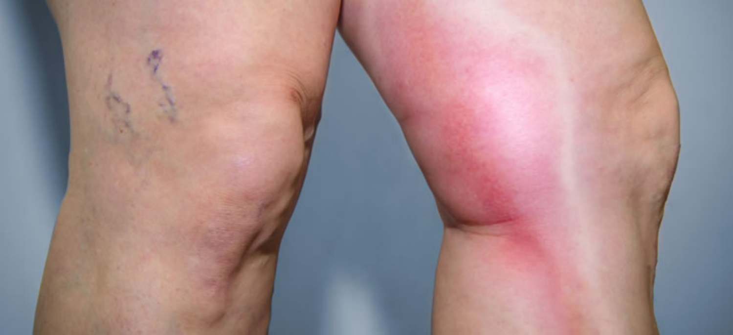 Các cách ngăn ngừa huyết khối tĩnh mạch sâu