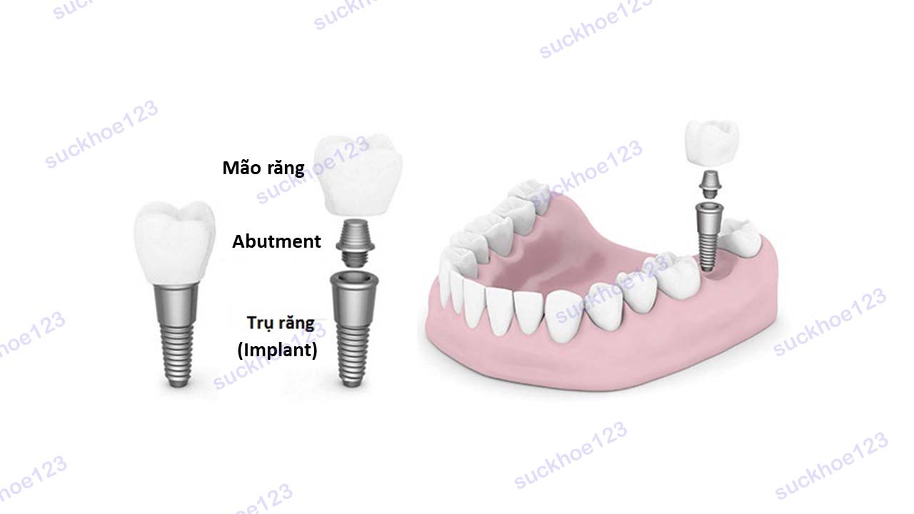 implant 1
