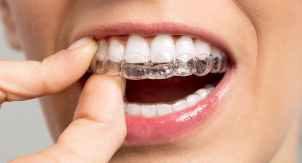 Invisalign là gì và có cơ chế hoạt động như thế nào?