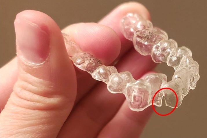 Khay niềng trong suốt Invisalign bị nứt, gãy: Cách xử trí