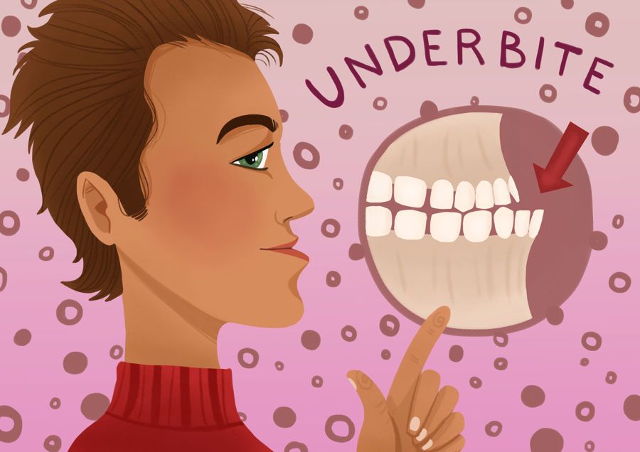 Những điều bạn cần biết về khớp cắn ngược và cách điều trị