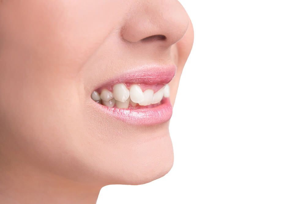Cần làm gì để khắc phục khớp cắn sâu?