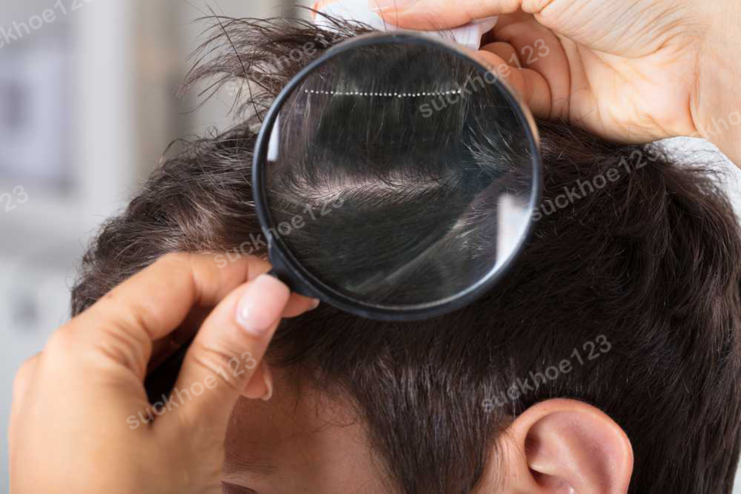 Một số kỹ thuật và xét nghiệm chẩn đoán rụng tóc