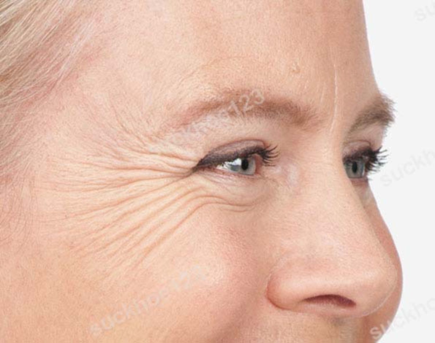 Các kỹ thuật xóa nếp nhăn đuôi mắt (nếp chân chim)