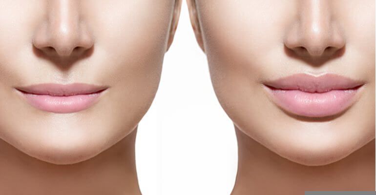 Các phương pháp làm đầy môi mỏng