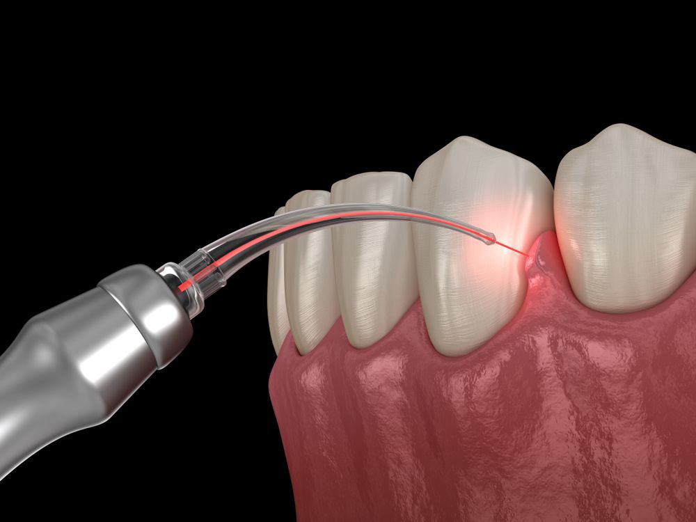 Liệu pháp laser nha chu LANAP