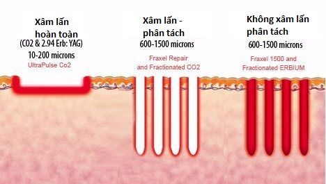Laser CO2