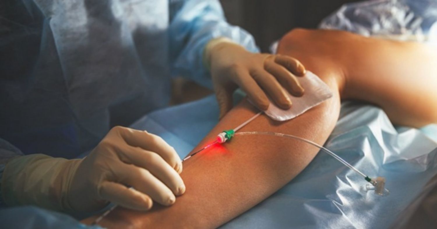 Laser nội tĩnh mạch có hiệu quả không?