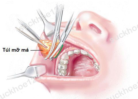 Lấy Túi Mỡ Má Ưu Nhược Điểm Bạn Cần Biết